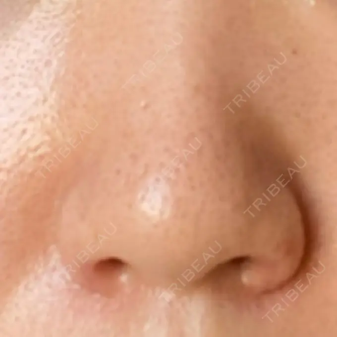 鼻孔縁挙上 シエルクリニック DAY 22 メイン用