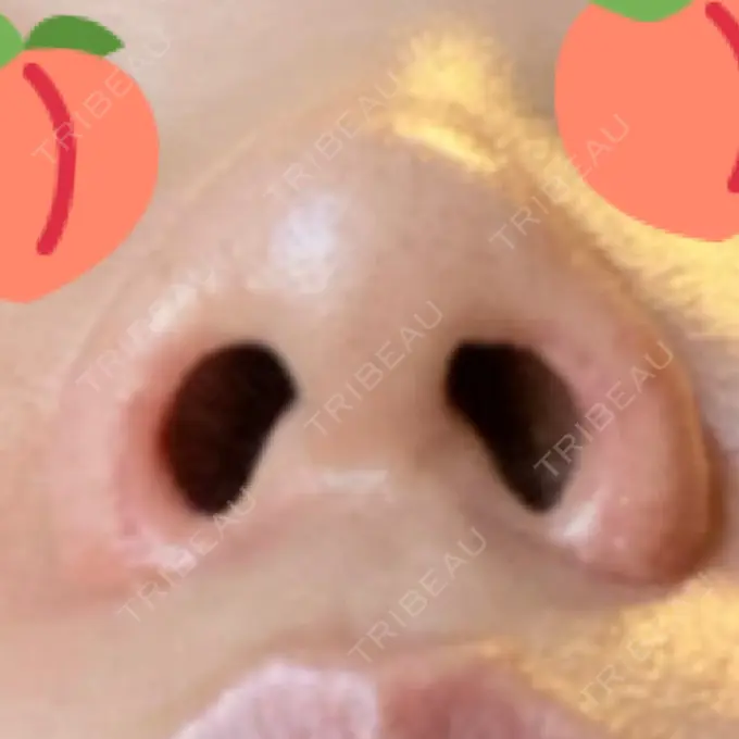 鼻孔縁挙上 シエルクリニック DAY 27 メイン用