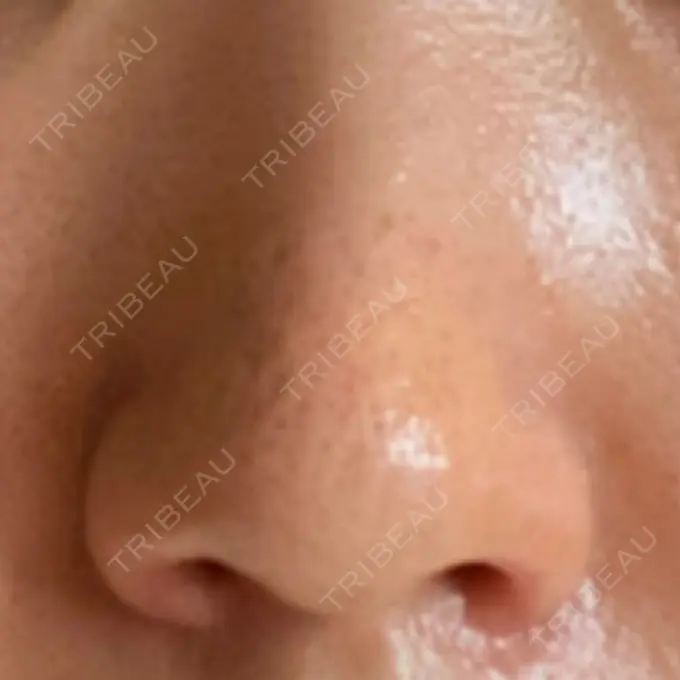 鼻孔縁挙上 シエルクリニック DAY 27 メイン用