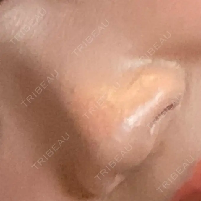 鼻孔縁挙上 シエルクリニック DAY 279 メイン用