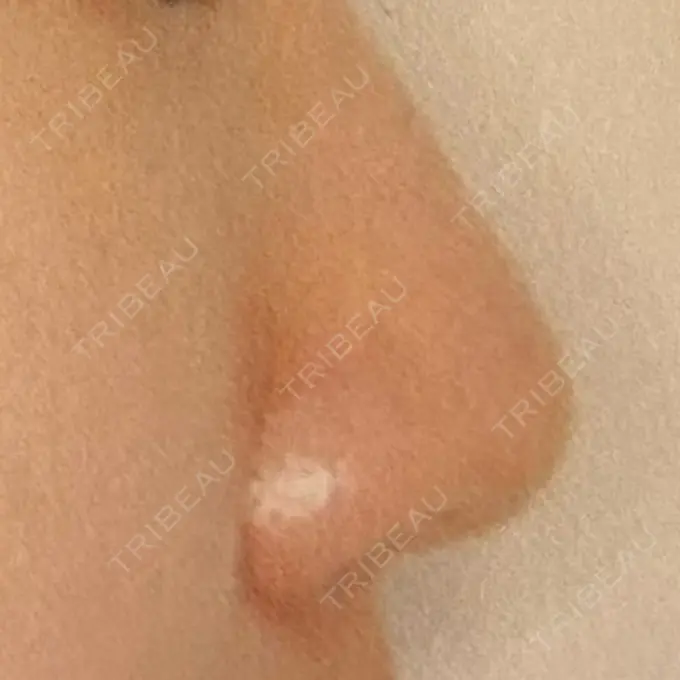 鼻孔縁挙上 シエルクリニック DAY 279 メイン用