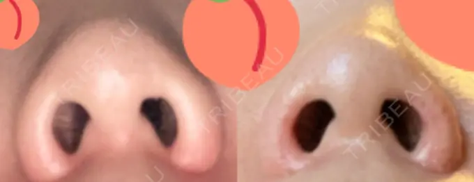 鼻孔縁挙上 シエルクリニック DAY 279 メイン用