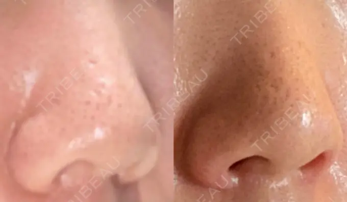 鼻孔縁挙上 シエルクリニック DAY 279 メイン用