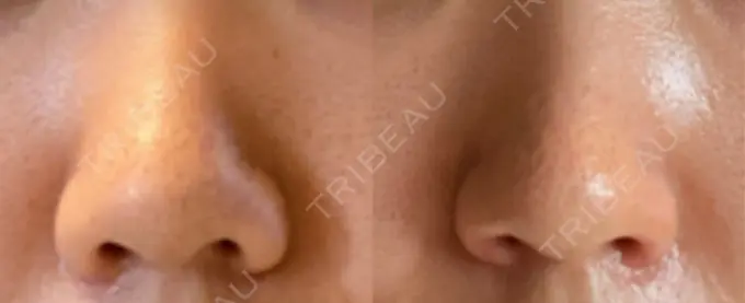 鼻孔縁挙上 シエルクリニック AFTER メイン用