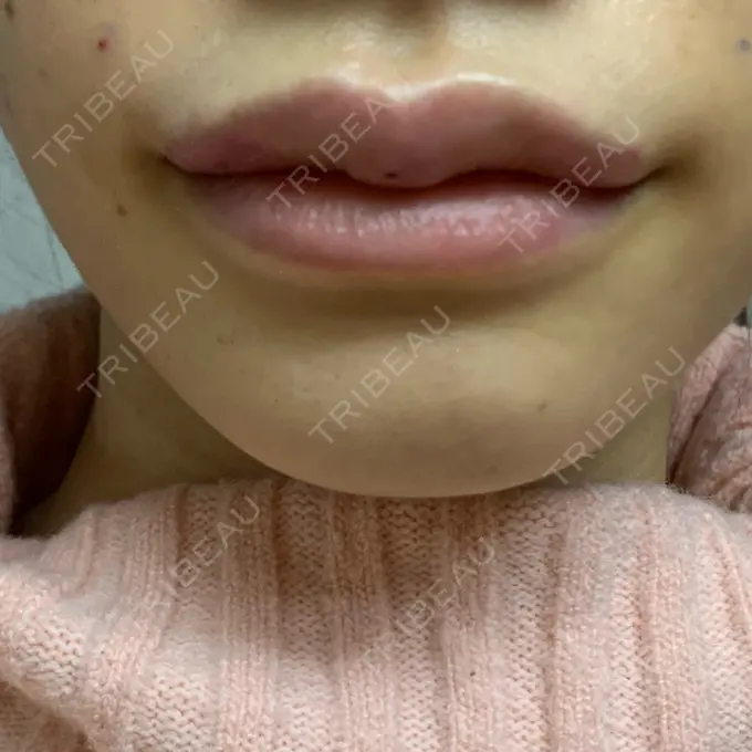 ヒアルロン酸注入（唇） / ボトックス（口角） ルラ美容クリニック 新宿院 DAY 1 メイン用