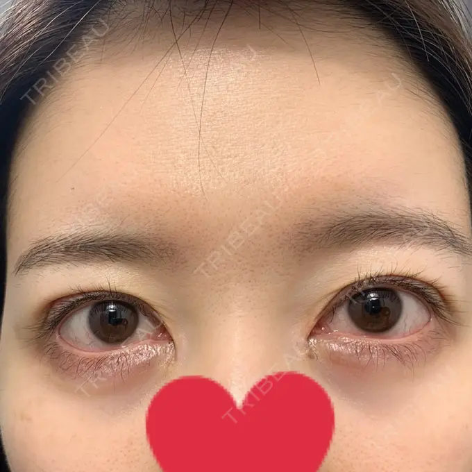 二重切開 / 目頭切開 心斎橋コムロ美容外科クリニック DAY 30 メイン用