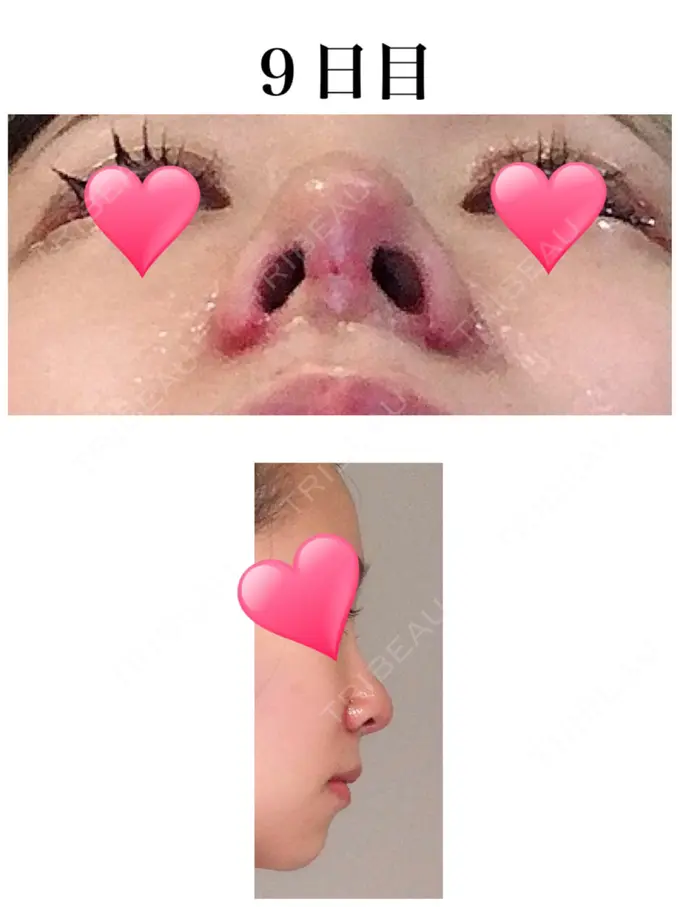 小鼻縮小（切開） / 軟骨移植 / 鼻尖縮小 麹町皮ふ科・形成外科クリニック DAY 9 メイン用