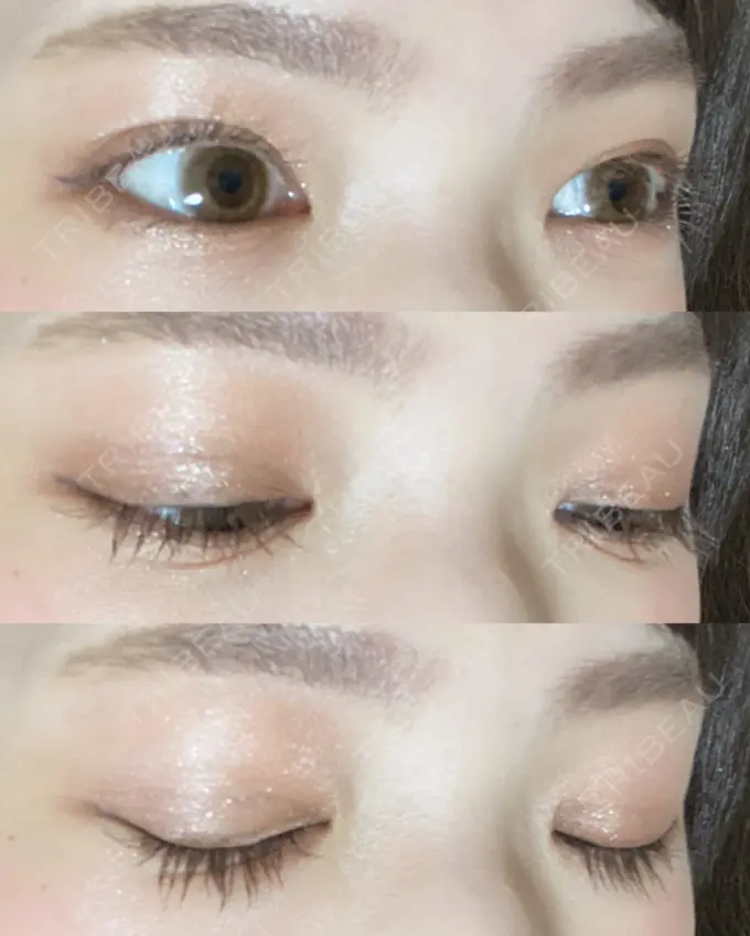 二重切開 有楽町高野美容クリニック DAY 233 メイン用