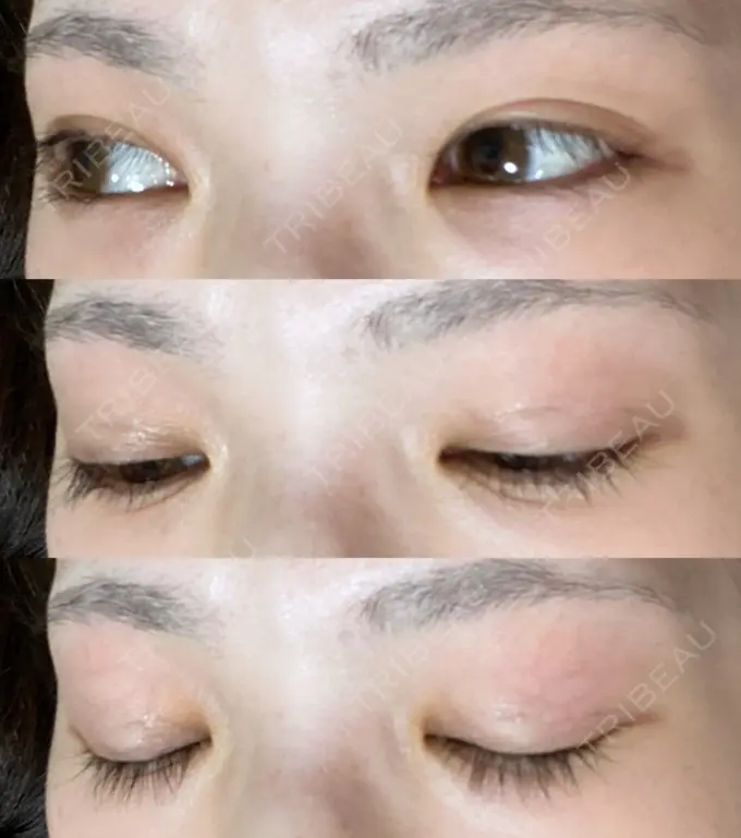 二重切開 有楽町高野美容クリニック DAY 244 メイン用