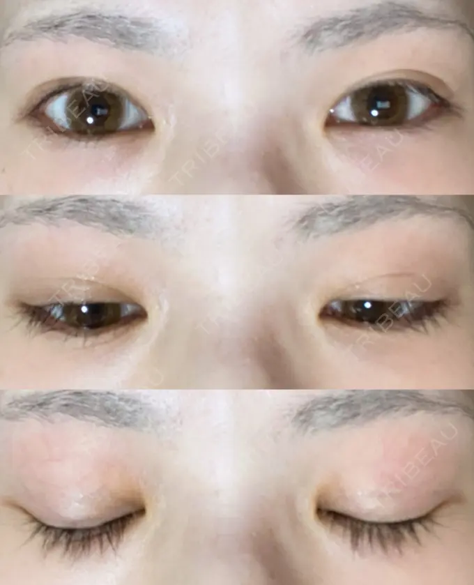 二重切開 有楽町高野美容クリニック DAY 244 メイン用