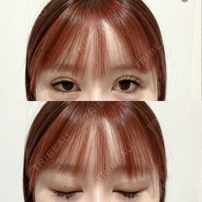 二重埋没 CLASSY 仙台美容外科・美容皮膚科 DAY 7 メイン用