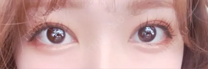 二重埋没 / ヒアルロン酸注入（目の下） EMMA CLINIC（エマクリニック） DAY 32 メイン用