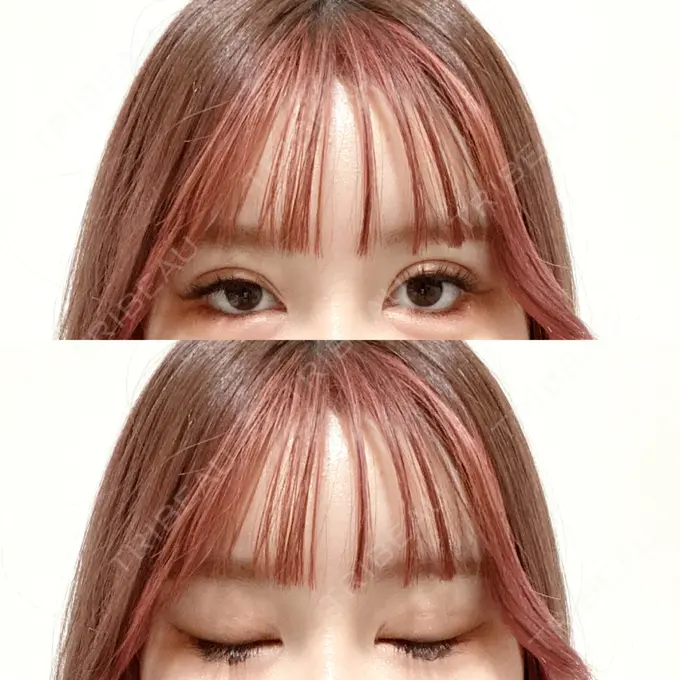 二重埋没 CLASSY 仙台美容外科・美容皮膚科 DAY 7 メイン用