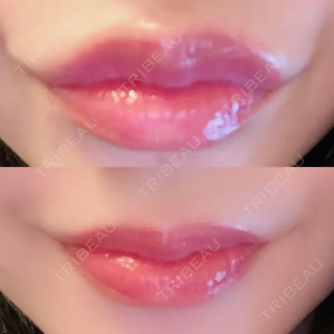 人中短縮 / ヒアルロン酸注入（唇） / ボトックス（口角） ルラ美容クリニック 高田馬場院 DAY 43 メイン用