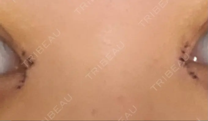 二重埋没 / 目頭切開 ドクター松井クリニック 新宿 DAY 3 メイン用