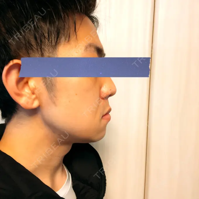 骨切り（あご） / 骨削り（エラ） 心斎橋コムロ美容外科クリニック DAY 43 メイン用