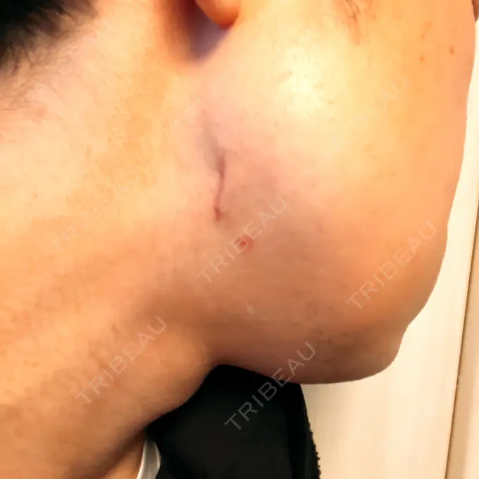 骨切り（あご） / 骨削り（エラ） 心斎橋コムロ美容外科クリニック DAY 43 メイン用