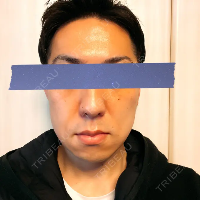 骨切り（あご） / 骨削り（エラ） 心斎橋コムロ美容外科クリニック DAY 43 メイン用