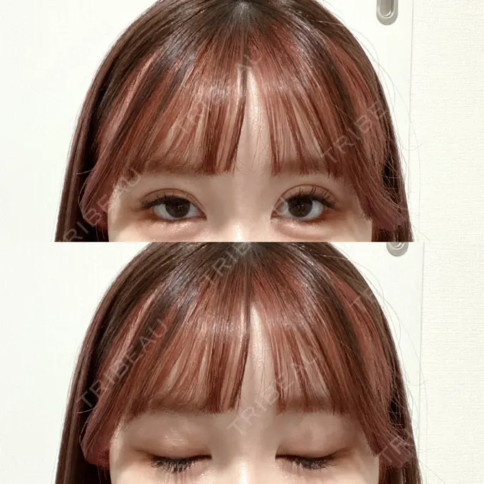 二重埋没 CLASSY 仙台美容外科・美容皮膚科 DAY 8 メイン用