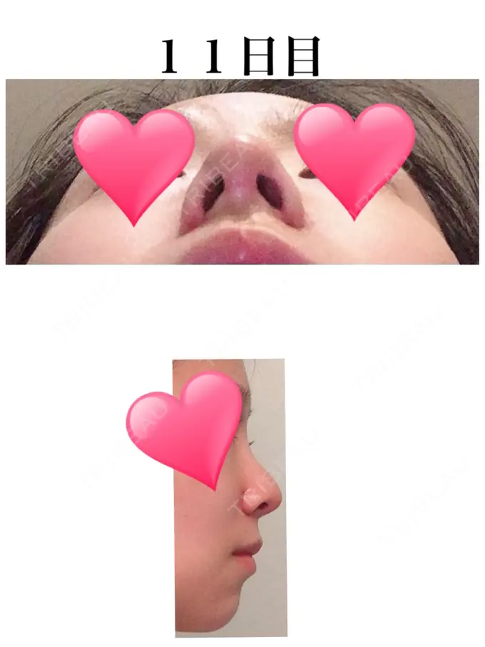 小鼻縮小（切開） / 軟骨移植 / 鼻尖縮小 麹町皮ふ科・形成外科クリニック DAY 11 メイン用