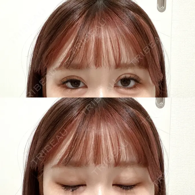 二重埋没 CLASSY 仙台美容外科・美容皮膚科 DAY 9 メイン用