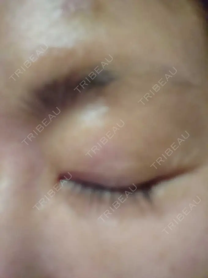 下まぶたたるみ取り / その他 湘南美容クリニック 千葉センシティ院 AFTER メイン用