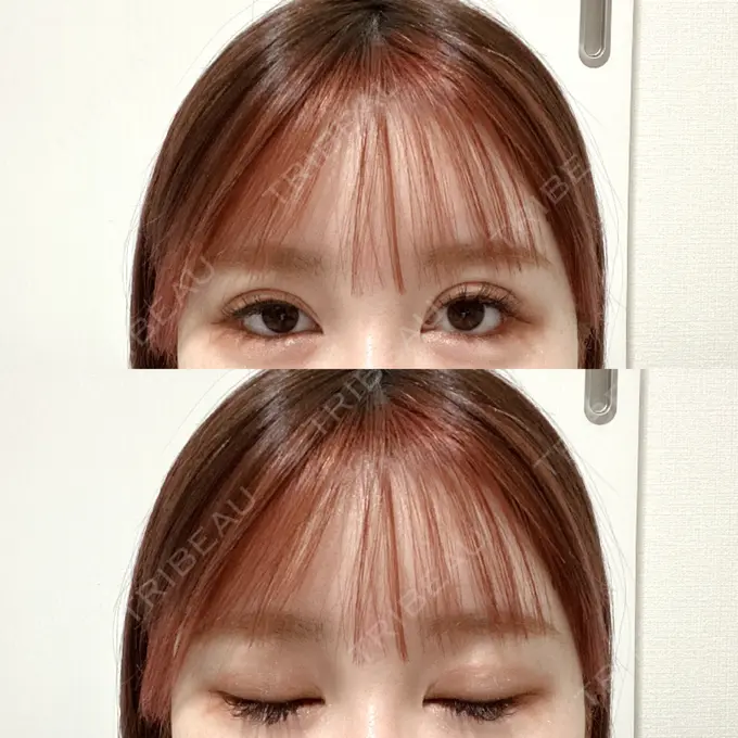 二重埋没 CLASSY 仙台美容外科・美容皮膚科 DAY 10 メイン用