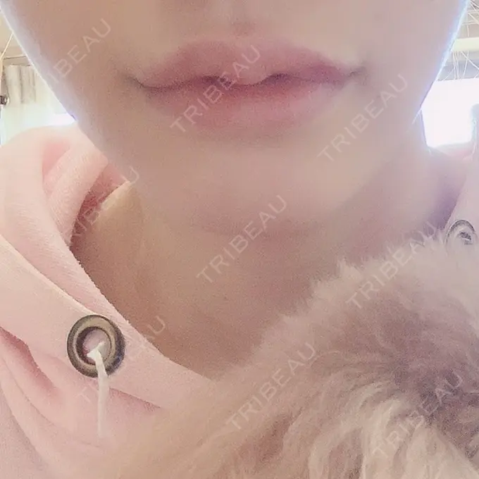 ヒアルロン酸注入（唇） / ボトックス（口角） ルラ美容クリニック 新宿院 DAY 3 メイン用