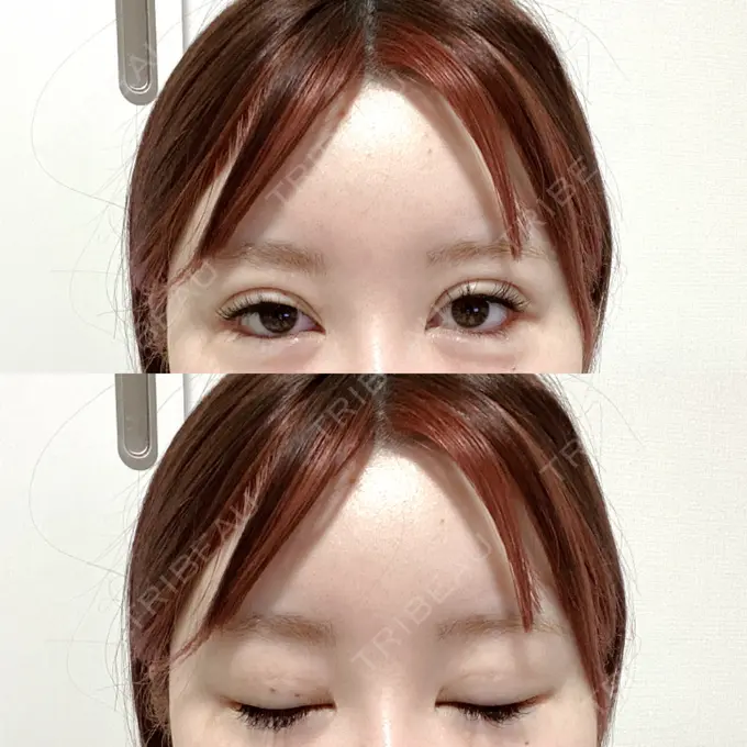 二重埋没 CLASSY 仙台美容外科・美容皮膚科 DAY 10 メイン用