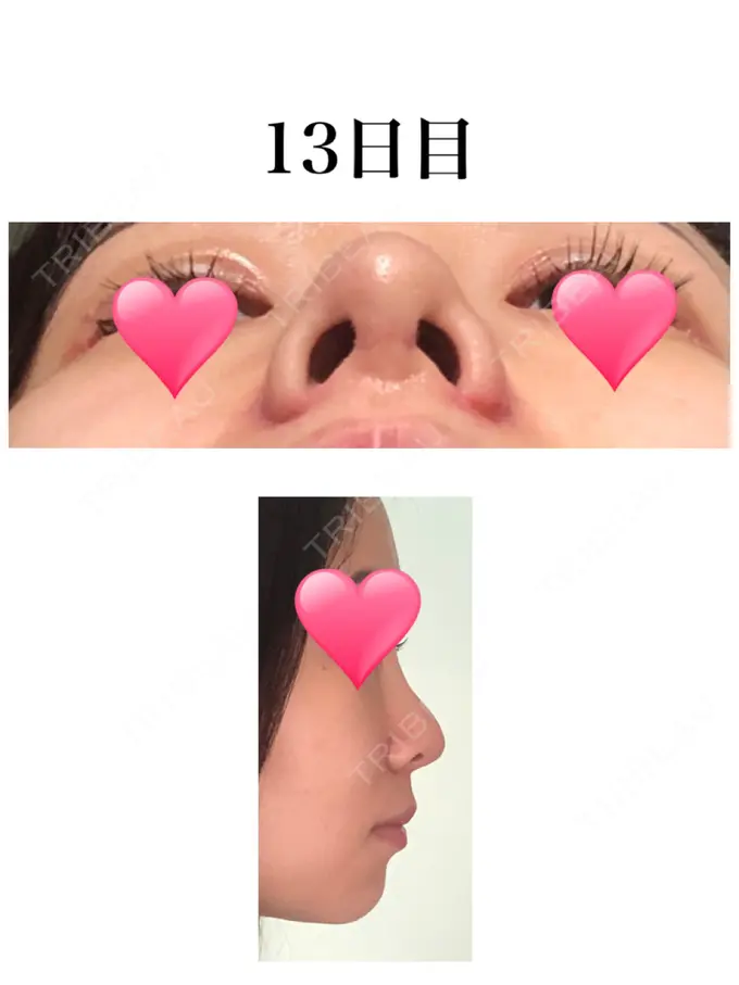 小鼻縮小（切開） / 軟骨移植 / 鼻尖縮小 麹町皮ふ科・形成外科クリニック DAY 13 メイン用