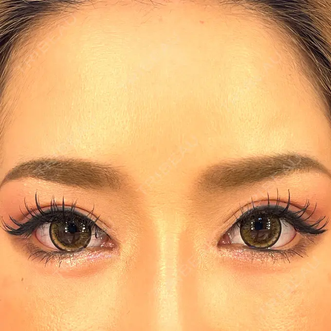 目頭切開 / 糸リフト / 目尻切開 / タレ目形成・グラマラスライン（切開） / メーラーファット除去 / ヒアルロン酸注入（涙袋） / ヒアルロン酸注入（あご） / ヒアルロン酸注入（唇） / ボトックス（口角） 大阪TAクリニック DAY 37 メイン用