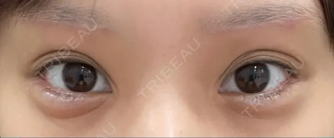 眉下切開 湘南美容クリニック 高田馬場院 DAY 38 メイン用