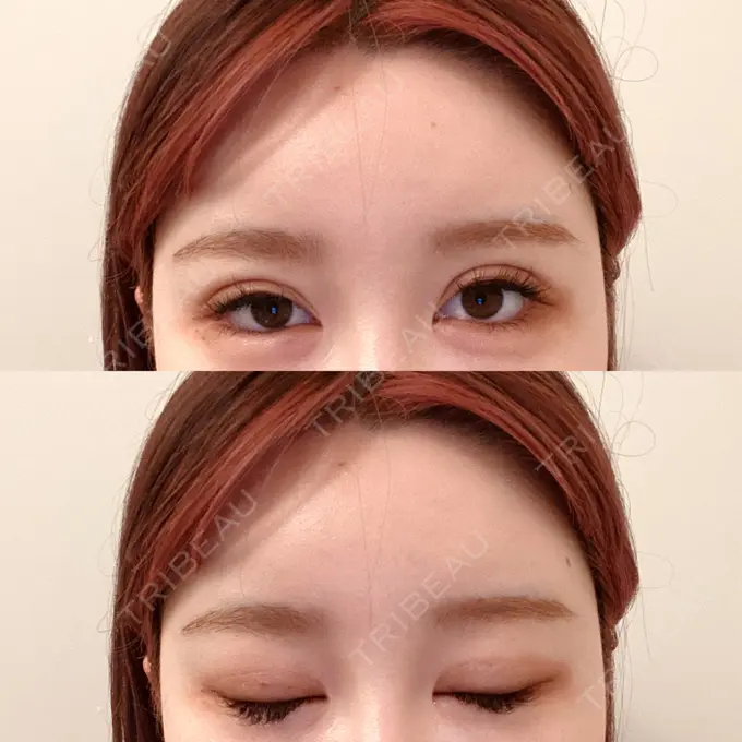 二重埋没 CLASSY 仙台美容外科・美容皮膚科 DAY 12 メイン用