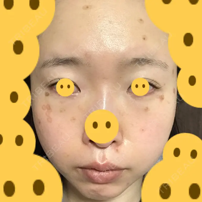 クマ治療 / 上まぶたたるみ取り / 下まぶたたるみ取り / シミ取りレーザー 赤坂プレミアクリニック DAY 4 メイン用