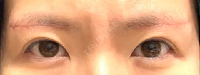 眉下切開 城本クリニック 福岡院 DAY 39 メイン用