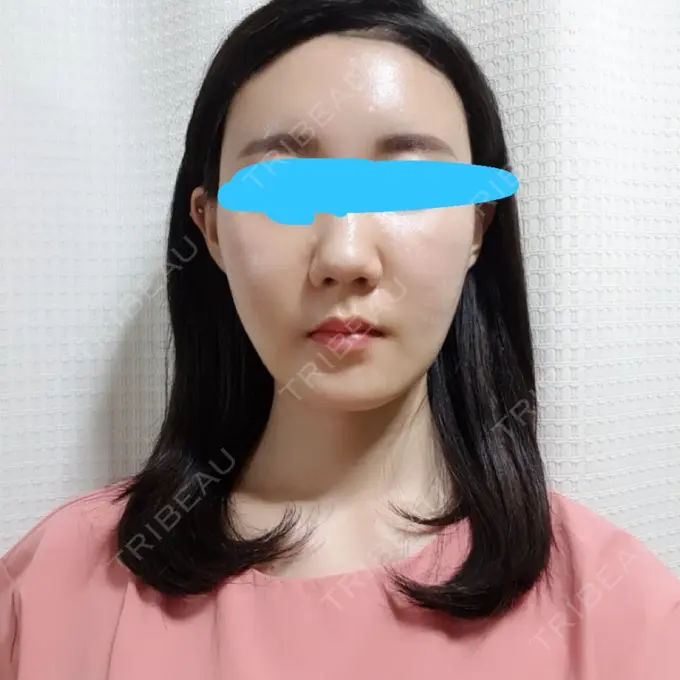 脂肪注入（輪郭） スノウ（Snow）整形外科 DAY 7 メイン用