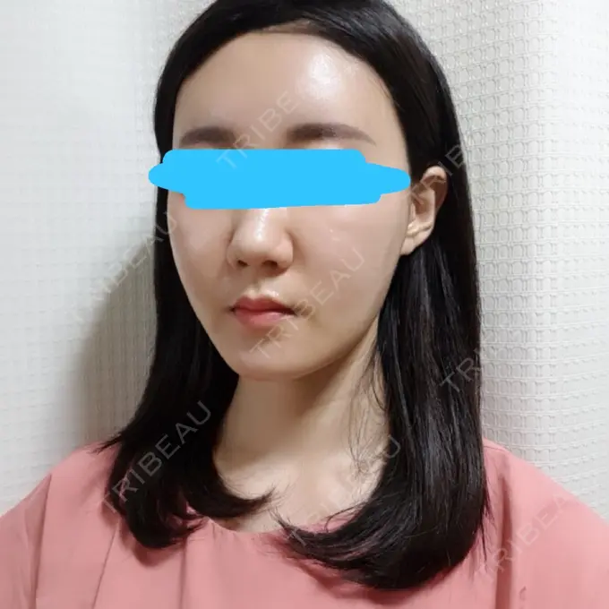 脂肪注入（輪郭） スノウ（Snow）整形外科 DAY 7 メイン用