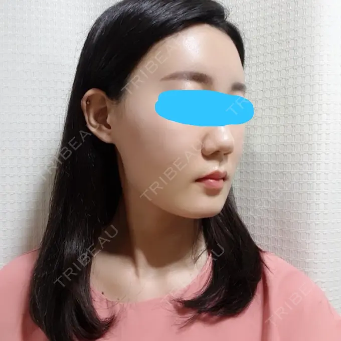 脂肪注入（輪郭） スノウ（Snow）整形外科 DAY 7 メイン用