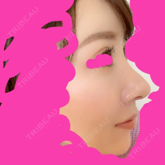 隆鼻術 / 鼻尖形成（切開） / 鼻中隔延長（切開） / 軟骨移植 / 鼻孔縁下降 Zetith Beauty Clinic 銀座院 DAY 18 メイン用