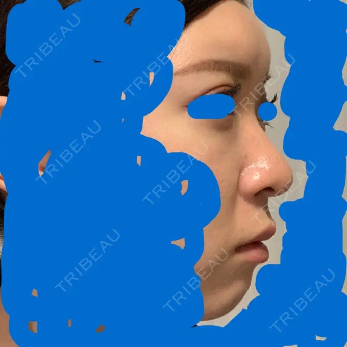 隆鼻術 / 鼻尖形成（切開） / 鼻中隔延長（切開） / 軟骨移植 / 鼻孔縁下降 Zetith Beauty Clinic 銀座院 DAY 18 メイン用