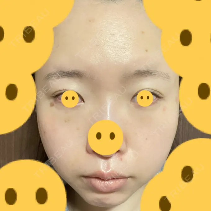 クマ治療 / 上まぶたたるみ取り / 下まぶたたるみ取り / シミ取りレーザー 赤坂プレミアクリニック DAY 5 メイン用