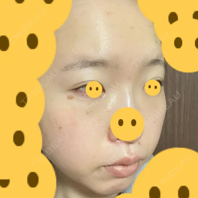 クマ治療 / 上まぶたたるみ取り / 下まぶたたるみ取り / シミ取りレーザー 赤坂プレミアクリニック DAY 5 メイン用