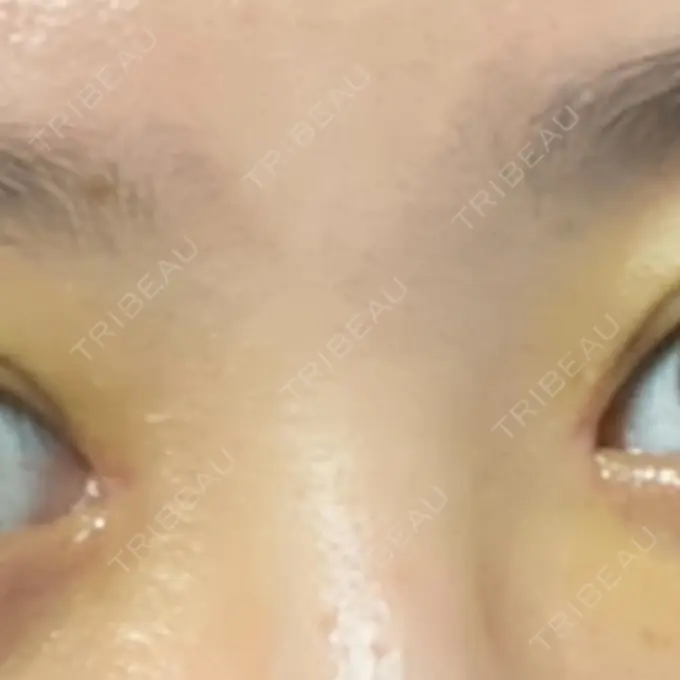 二重埋没 / 目頭切開 ドクター松井クリニック 新宿 DAY 6 メイン用