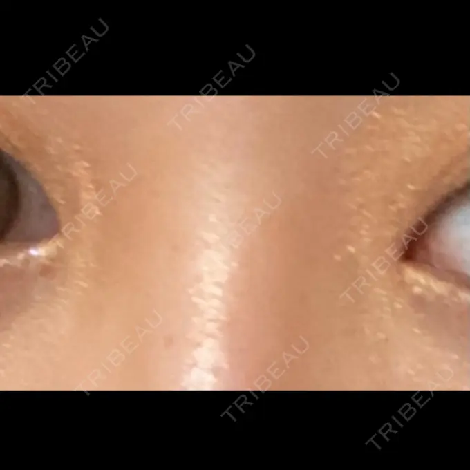 二重埋没 / 目頭切開 ドクター松井クリニック 新宿 AFTER メイン用