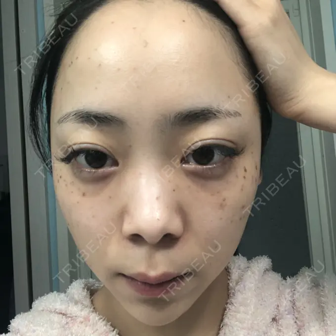 ほくろ・いぼ切除（肌） / シミ取りレーザー / ピコレーザートーニング（美白・肝斑） セオリークリニック DAY 5 メイン用