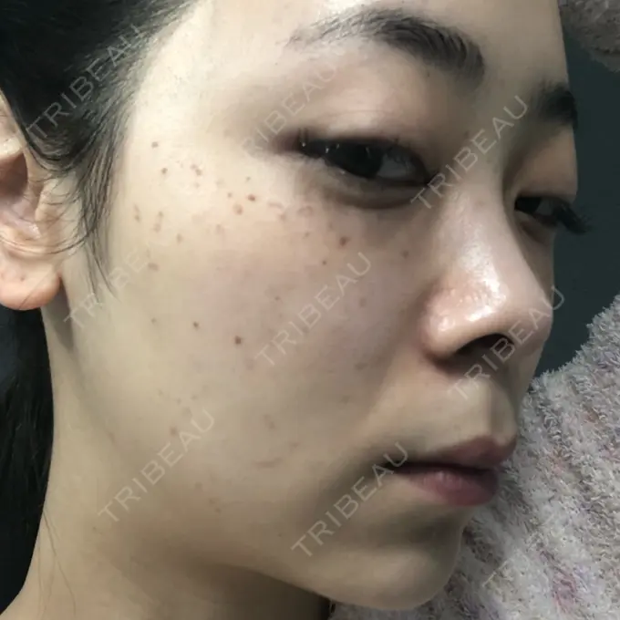 ほくろ・いぼ切除（肌） / シミ取りレーザー / ピコレーザートーニング（美白・肝斑） セオリークリニック DAY 5 メイン用