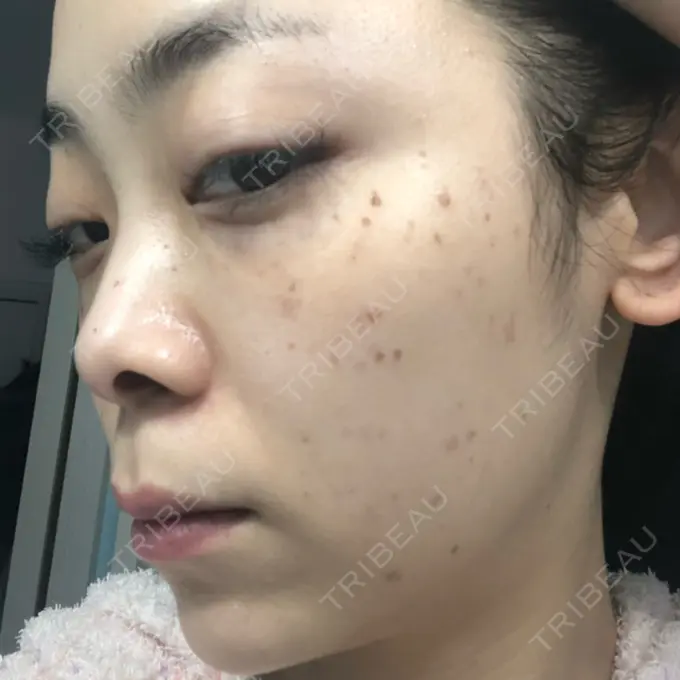 ほくろ・いぼ切除（肌） / シミ取りレーザー / ピコレーザートーニング（美白・肝斑） セオリークリニック DAY 5 メイン用