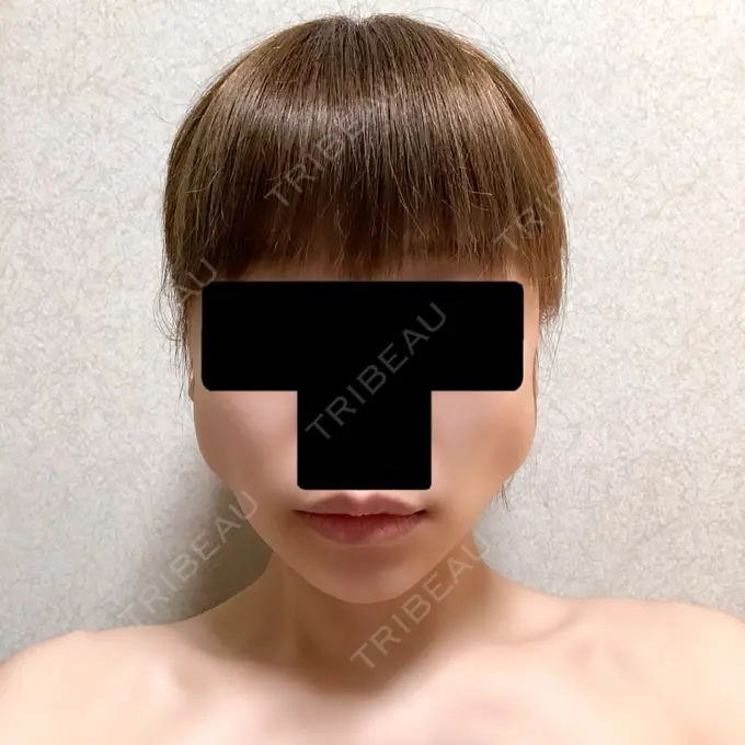 バッカルファット除去 / ボトックス（エラ・小顔） 湘南美容クリニック 金山院 DAY 5 メイン用