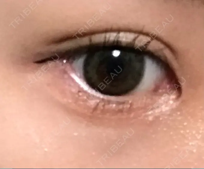 二重埋没 かわた美容クリニック DAY 45 メイン用