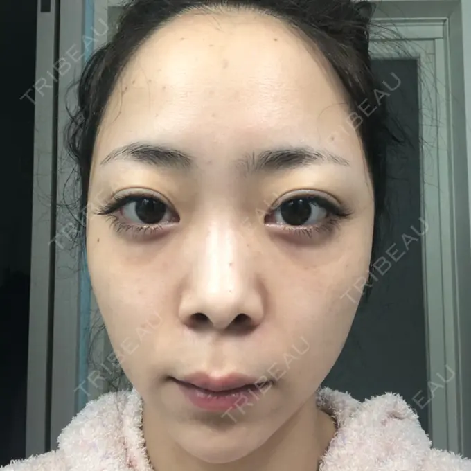 ほくろ・いぼ切除（肌） / シミ取りレーザー / ピコレーザートーニング（美白・肝斑） セオリークリニック DAY 6 メイン用